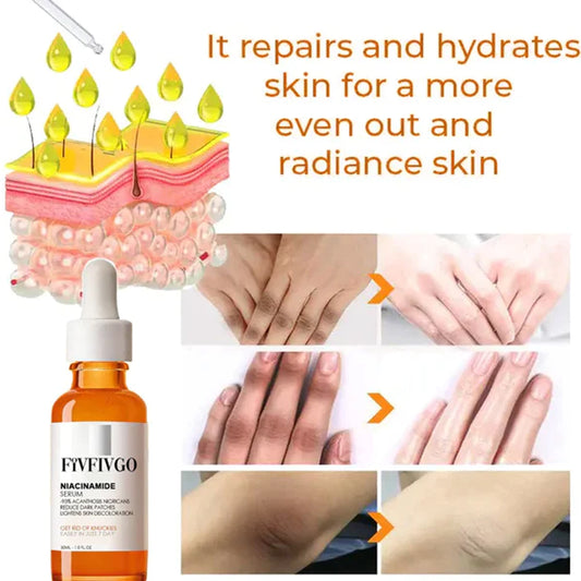 Advanced Skin Brightening Serum for Entfernung Von Melanose Und Dunklen Flecken