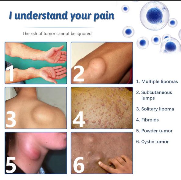 Doctor's No 1 choice | Lipoma Removal Cream (Pack of 1)