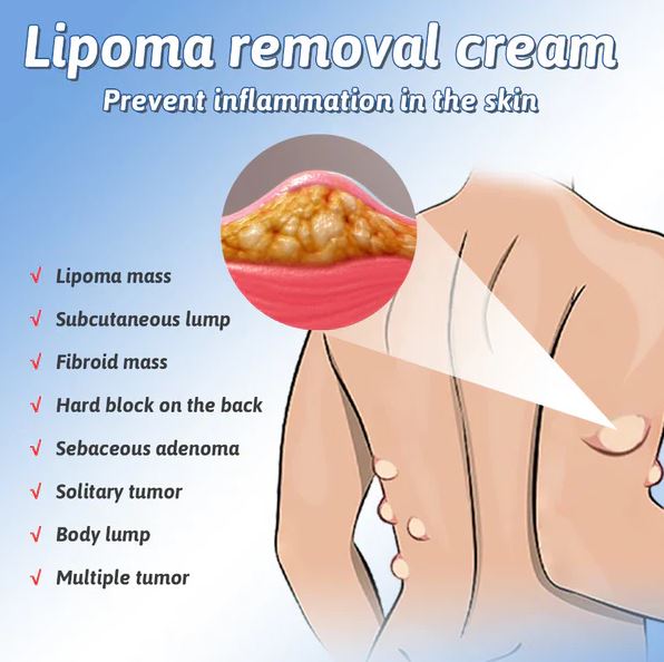 Doctor's No 1 choice | Lipoma Removal Cream (Pack of 1)